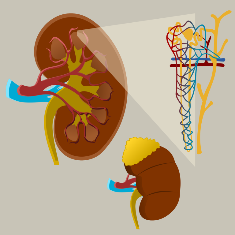 Nephrotic syndrome