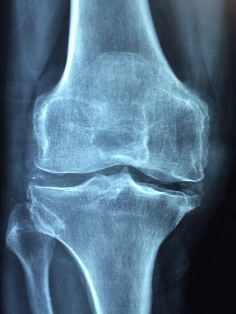 Rheumatoid arthritis